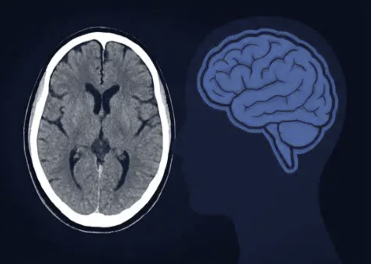 CT brain scan showing anatomical structures